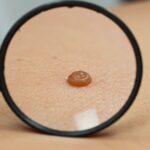 A close-up image of a skin mole on a person's body, with a dermatologist examining it using a magnifying glass. The image highlights the importance of professional skin evaluation for mole removal.